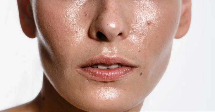 ویژگی های پوست چرب